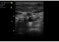 Establishing a VTE Risk Score for Astronauts Algorithm